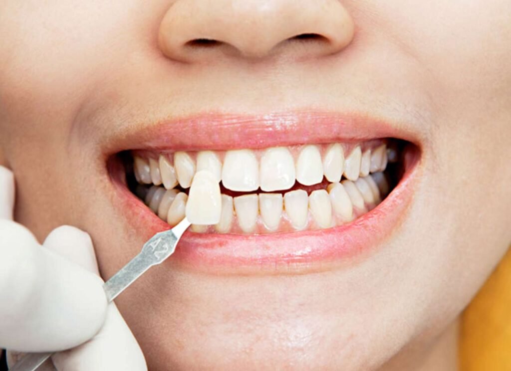 Aussie Style, Perfect Smile: Elevate Your Look with Dental Veneers Dental Veneers