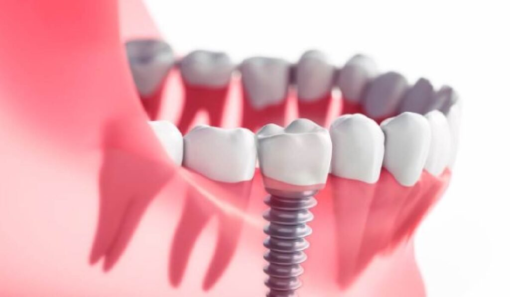 Dental Implant Surgery Timeline in Turkey: From Consultation to Final Crown